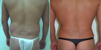 reshape od the butt with fat transfer from abdomen,lumbar lipoaspiration